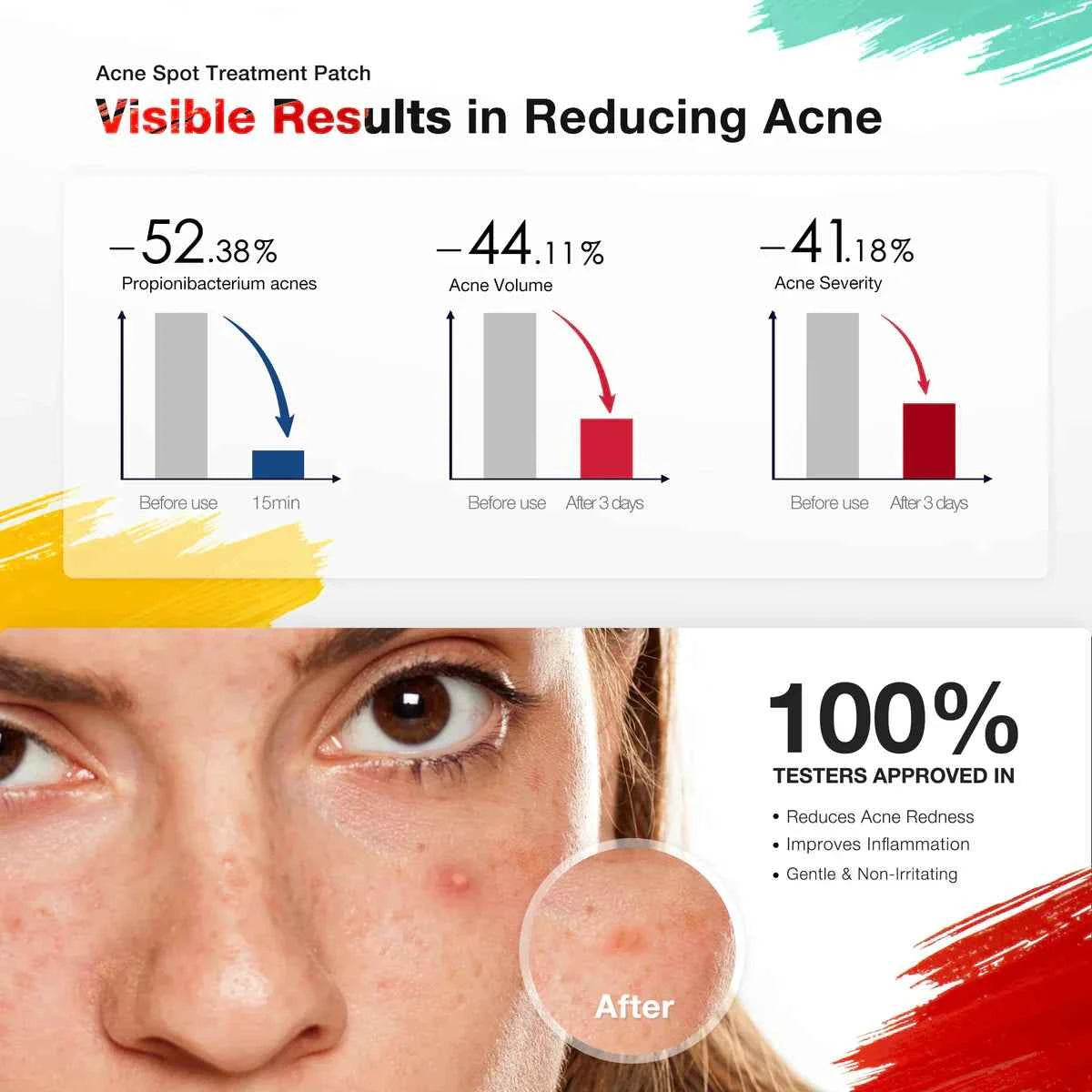 Acnebye Electronic Acne Patches 6pcs with extra patches