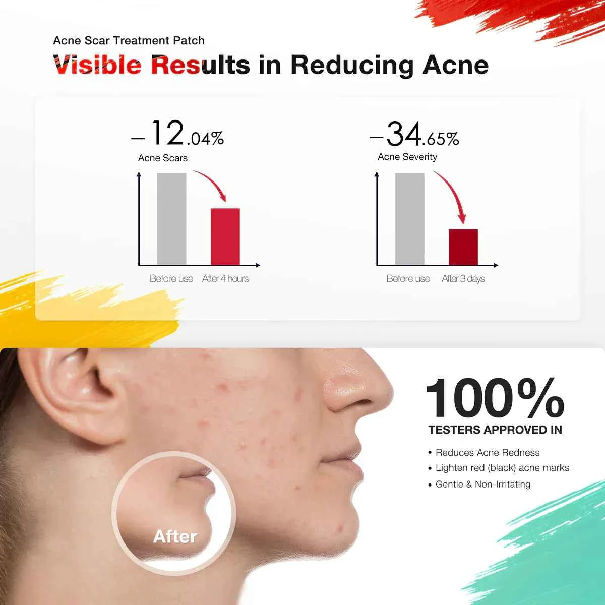 Acnebye Electronic Acne Patches 6pcs with extra patches